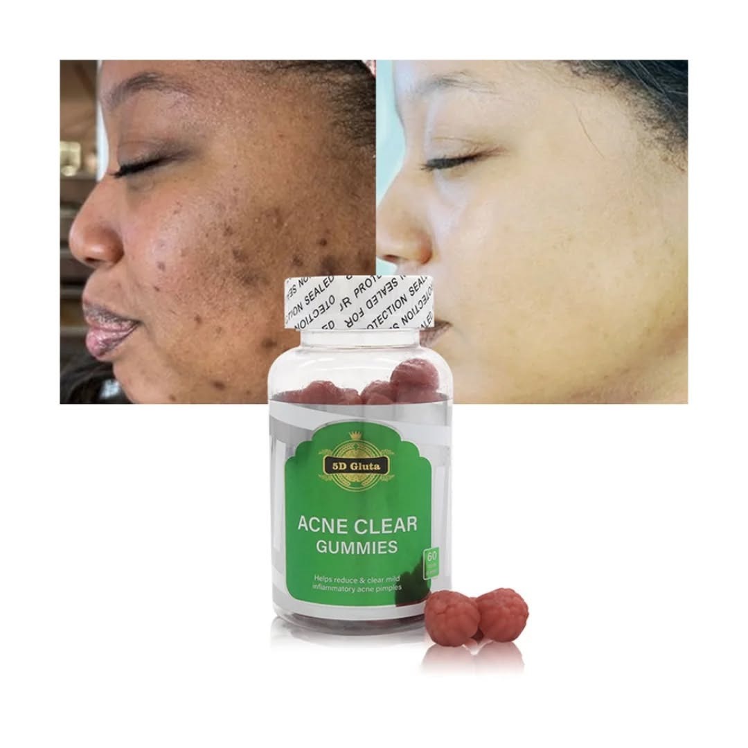 5D Gluta Acne Clear Gummies