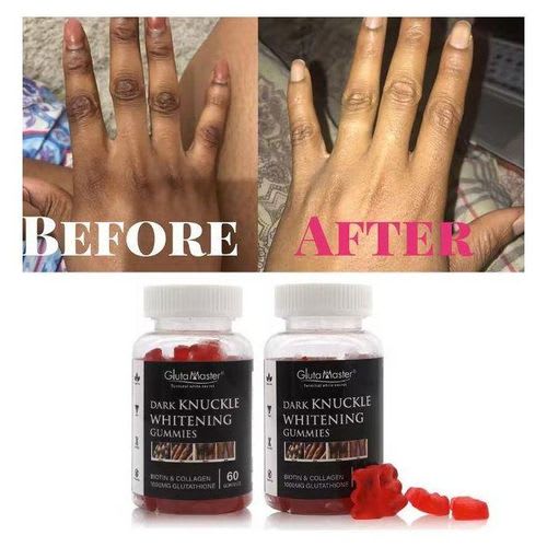 Gluta Master Dark knuckles whitening gummies with biotin,collagen and glutathione lightening brightening gummies